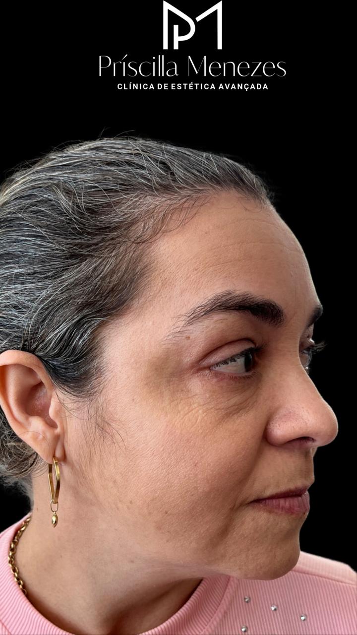 Procedimento Estético Dra Príscilla Menezes