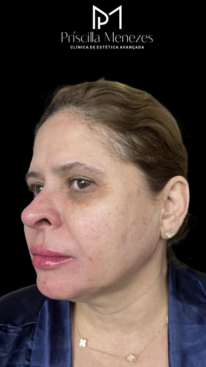 Procedimento Estético Dra Príscilla Menezes