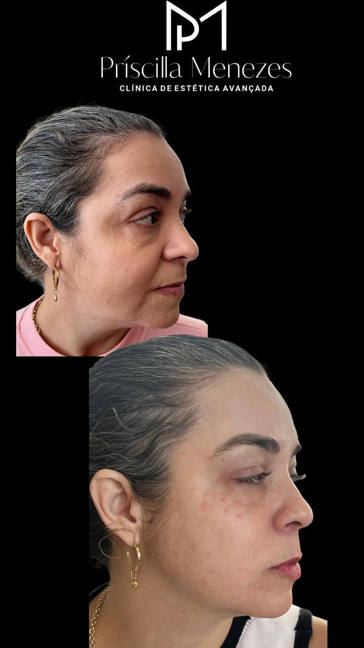 Procedimento Estético Dra Príscilla Menezes