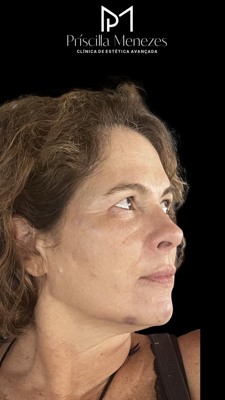 Procedimento Estético Dra Príscilla Menezes