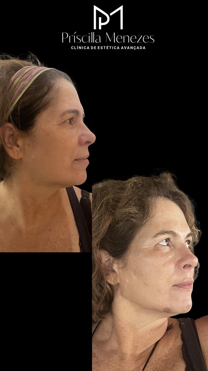 Procedimento Estético Dra Príscilla Menezes