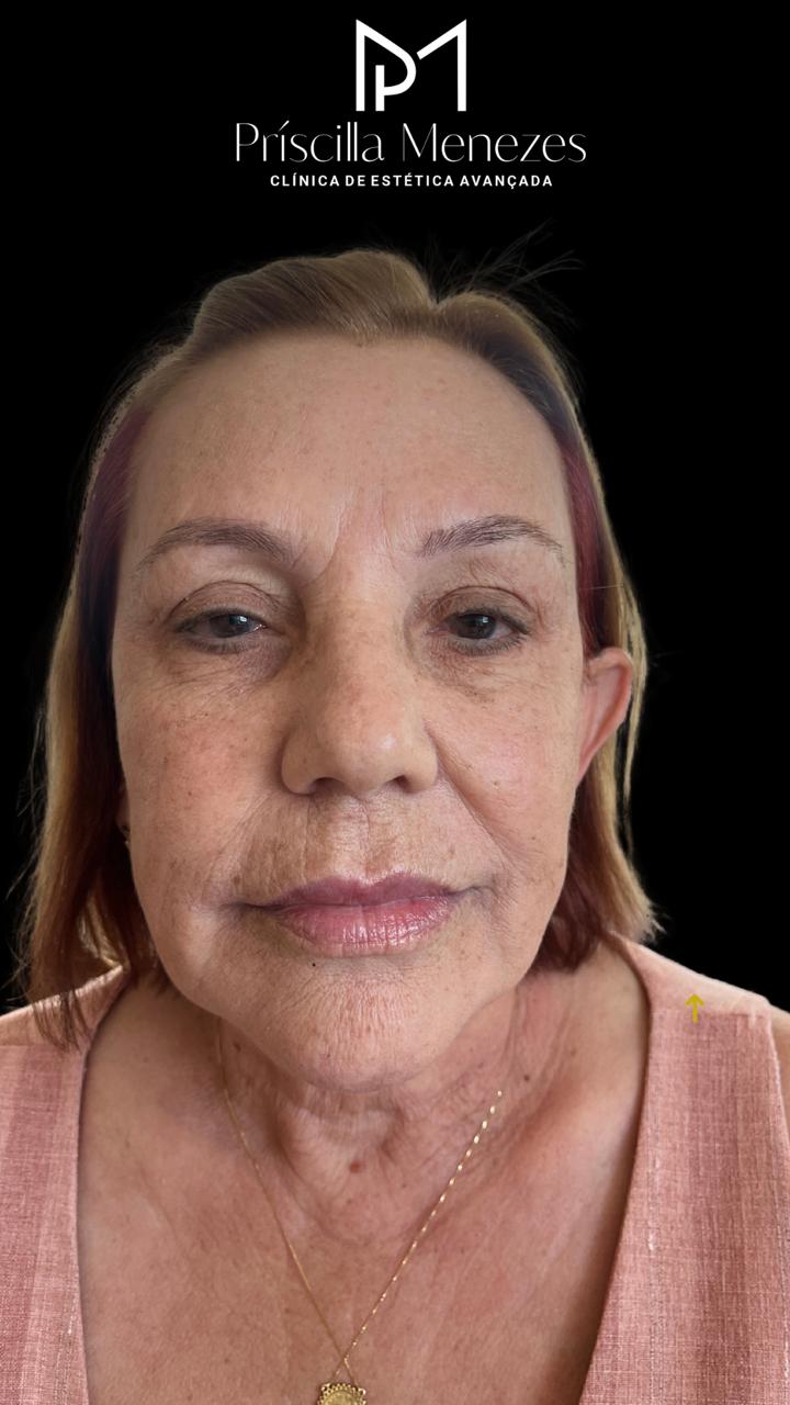Procedimento Estético Dra Príscilla Menezes