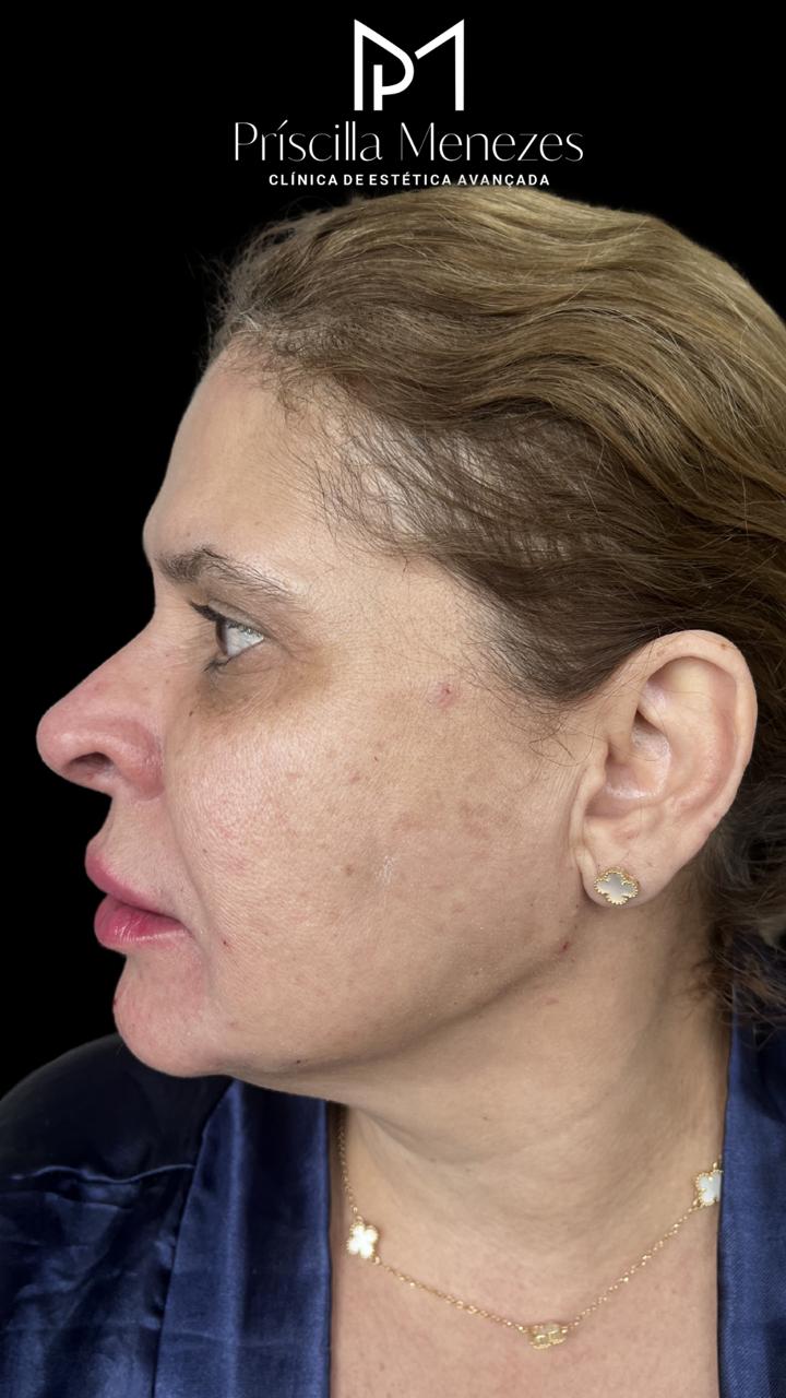 Procedimento Estético Dra Príscilla Menezes