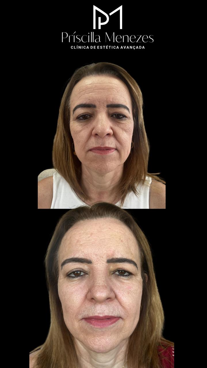 Procedimento Estético Dra Príscilla Menezes