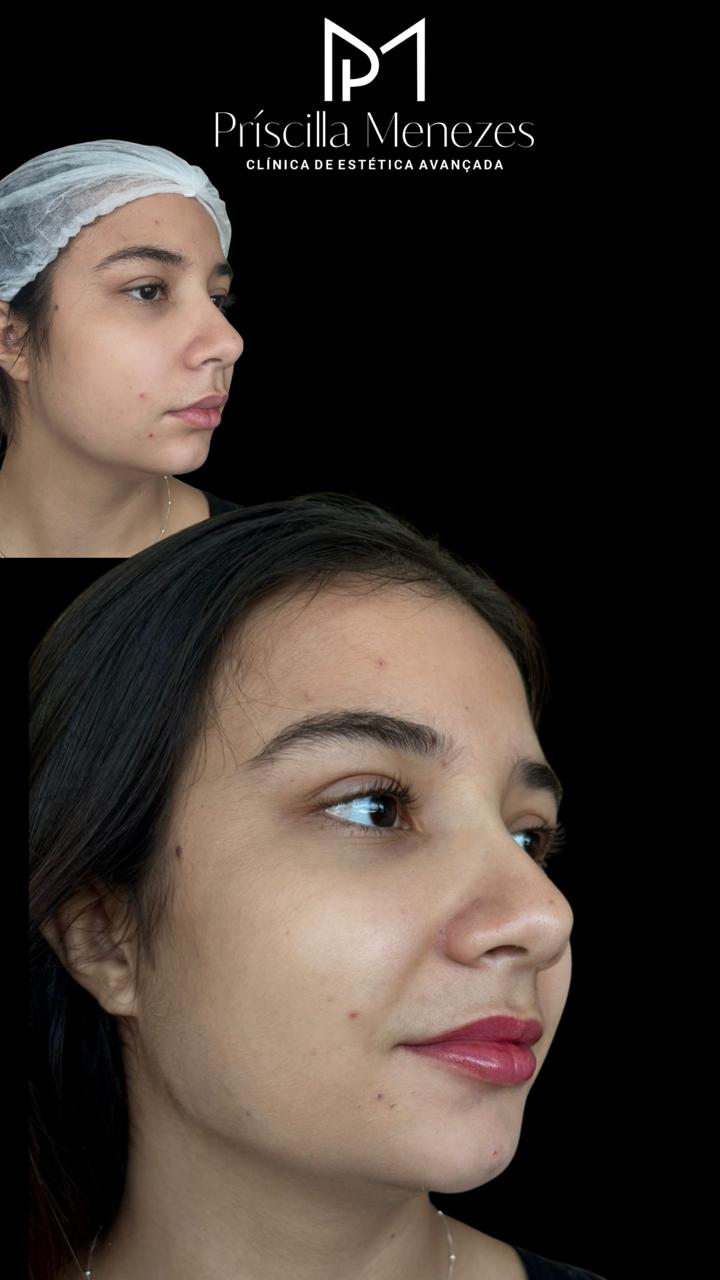 Procedimento Estético Dra Príscilla Menezes