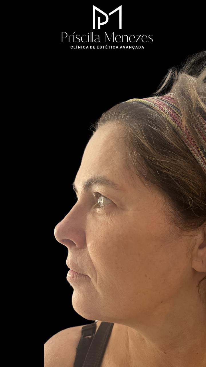 Procedimento Estético Dra Príscilla Menezes