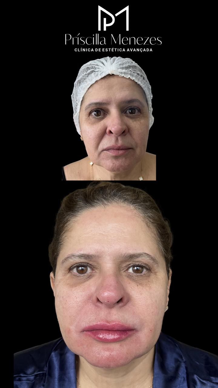 Procedimento Estético Dra Príscilla Menezes