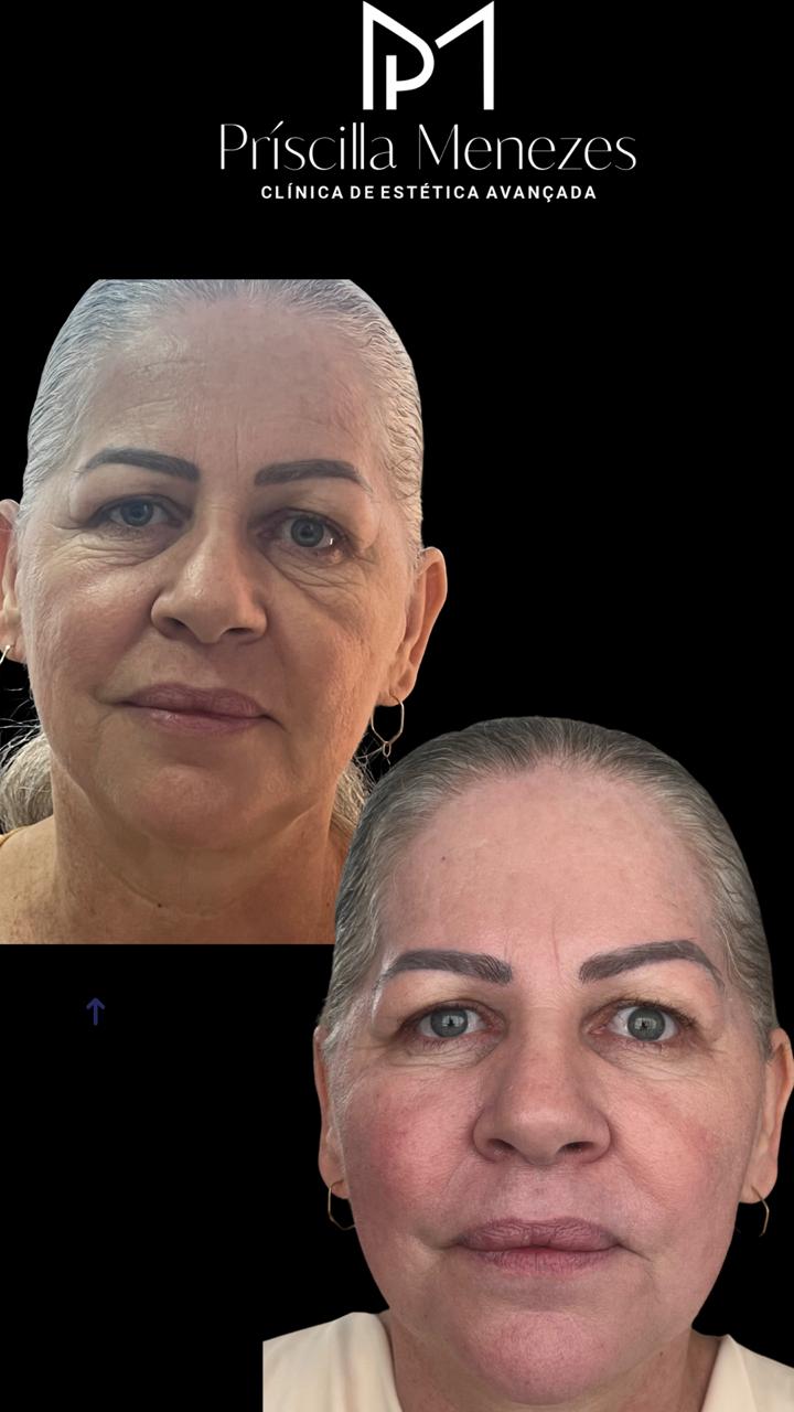 Procedimento Estético Dra Príscilla Menezes