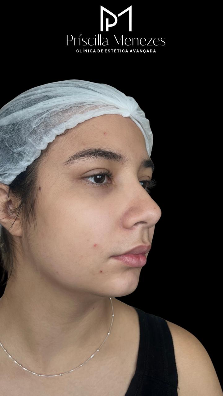 Procedimento Estético Dra Príscilla Menezes