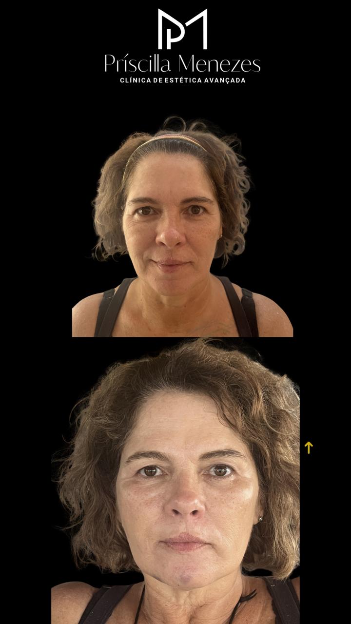 Procedimento Estético Dra Príscilla Menezes