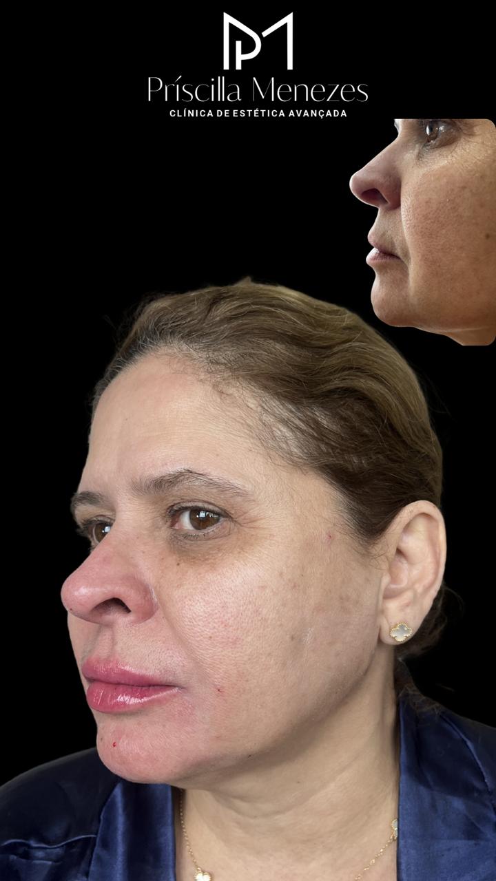 Procedimento Estético Dra Príscilla Menezes