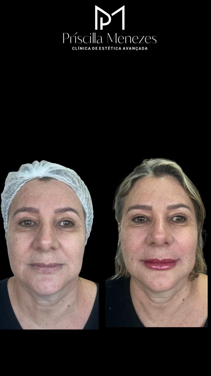 Procedimento Estético Dra Príscilla Menezes