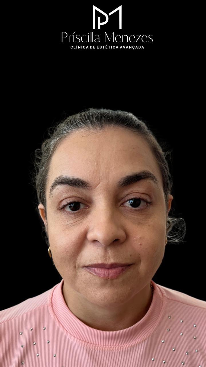Procedimento Estético Dra Príscilla Menezes