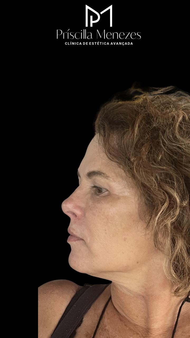 Procedimento Estético Dra Príscilla Menezes