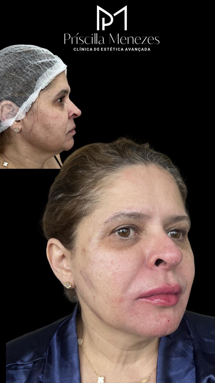 Procedimento Estético Dra Príscilla Menezes