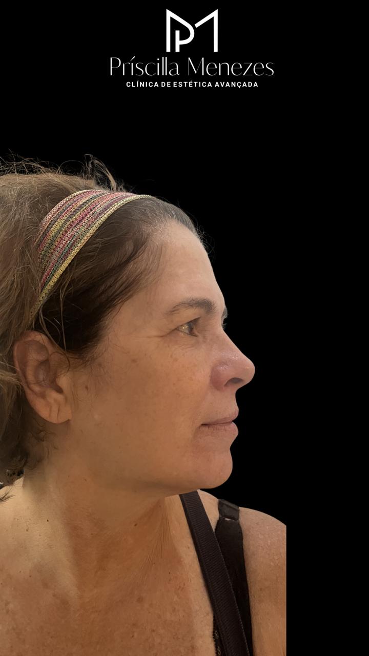 Procedimento Estético Dra Príscilla Menezes
