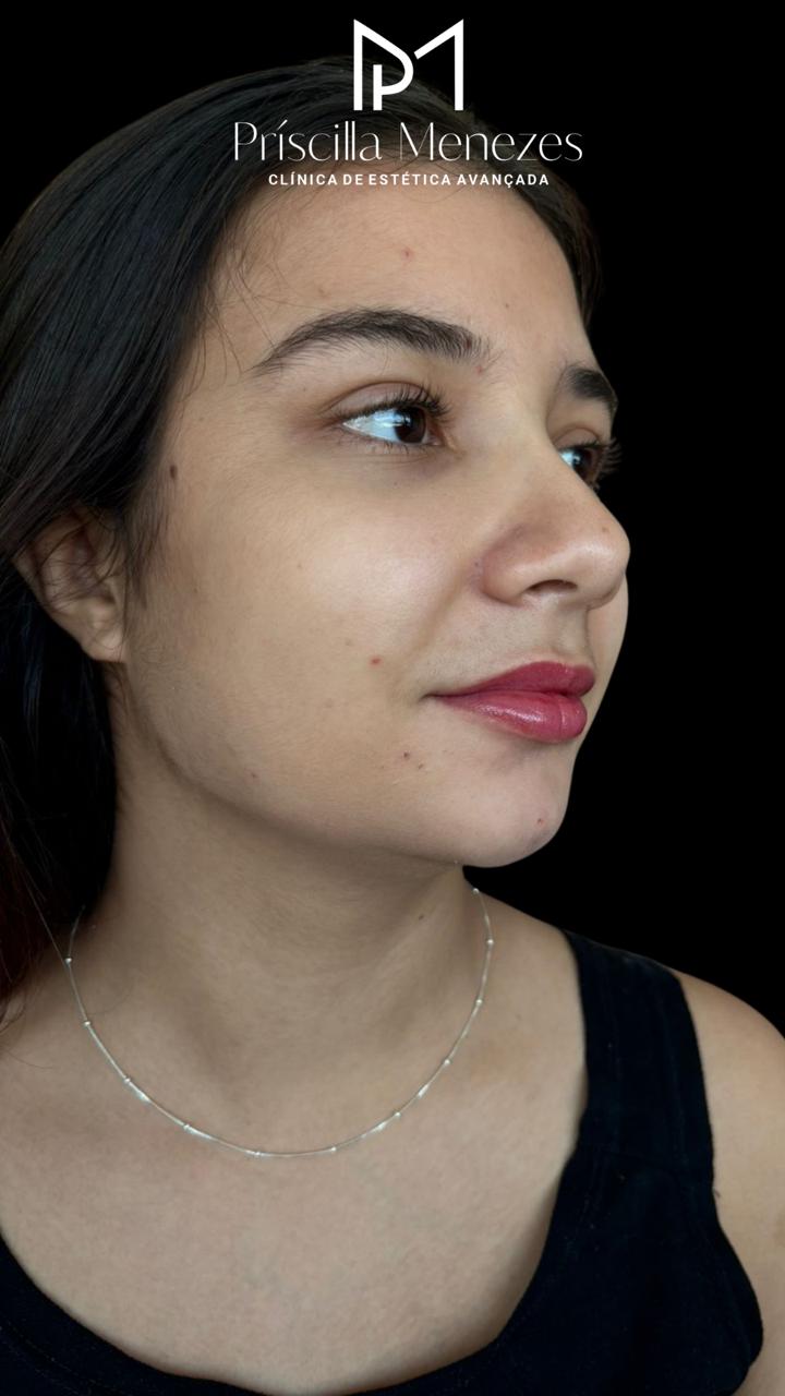 Procedimento Estético Dra Príscilla Menezes